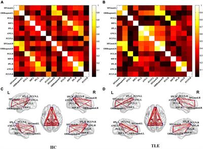 Abnormal metabolic connectivity in default mode network of right temporal lobe epilepsy